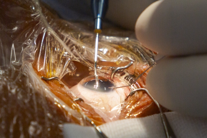 El codirector de FacoElche se somete en directo a la implantación bilateral de una lente diseñada con IA